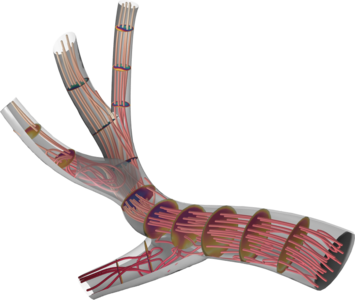 狭窄肺动脉中的血流