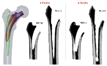Bone Remodeling Following ...