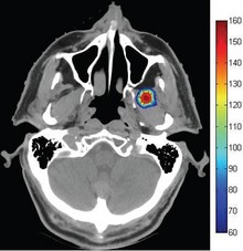 Virtual Thermal Ablation in ...