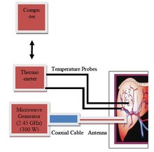 Microwave Interstitial ...