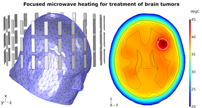 Treating Brain Cancer with ...